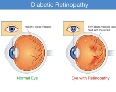 Diabetic Retinopathy Treatment: A Comprehensive Guide by Dr. Neha Tiwari Diabetic Retinopathy