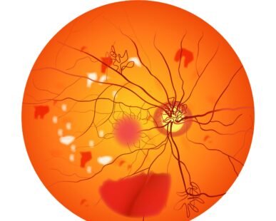 diabetic retinopathy