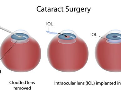 Cataract Surgery : SICS & PHACO